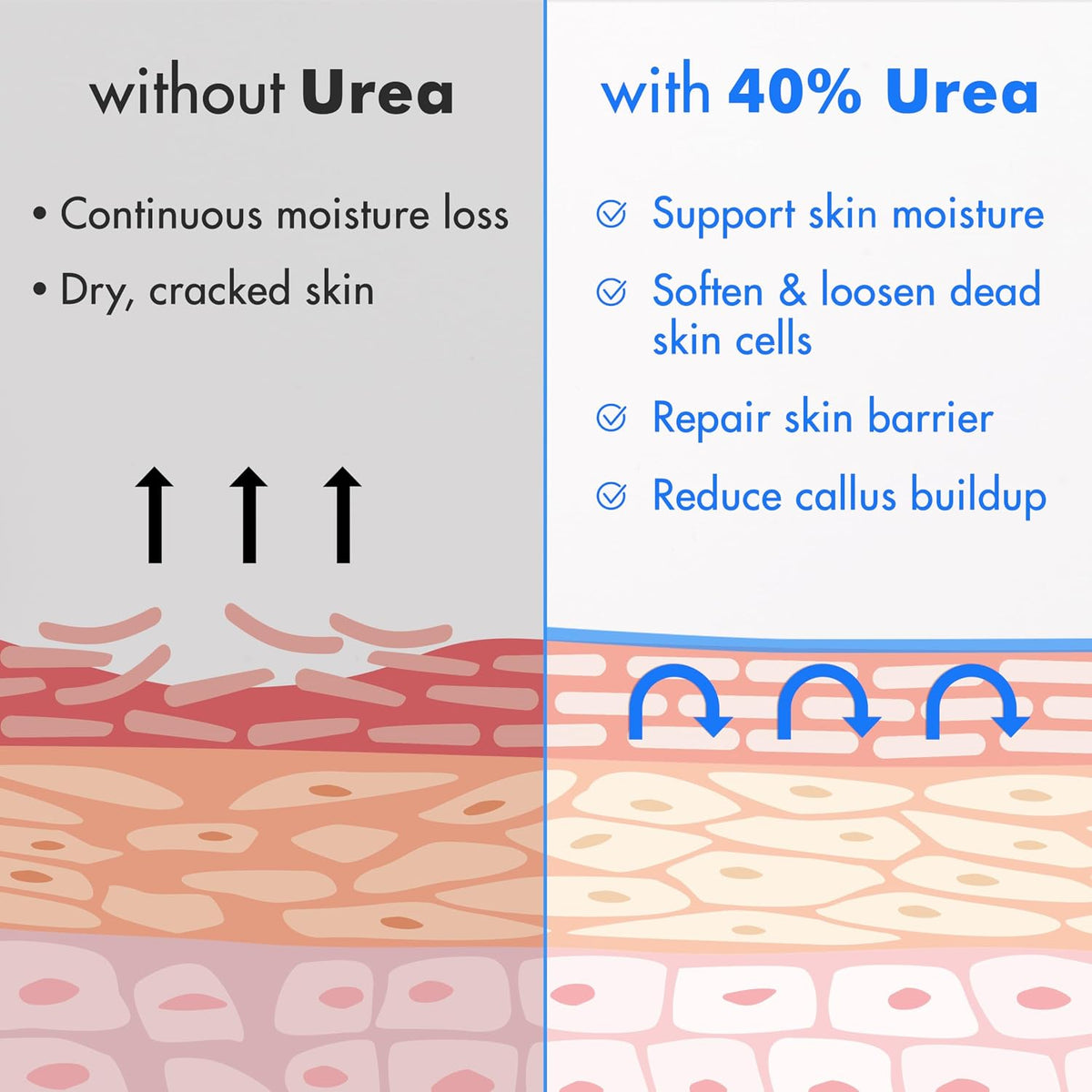 Comparison of skin conditions with and without 40% Urea, showing benefits on a gray and blue background.