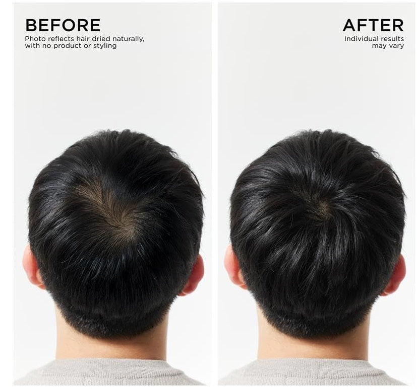 Before and after comparison of back head showing natural hair thinning and fuller hair after treatment