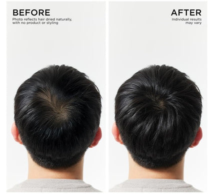 Before and after comparison of back head showing natural hair thinning and fuller hair after treatment